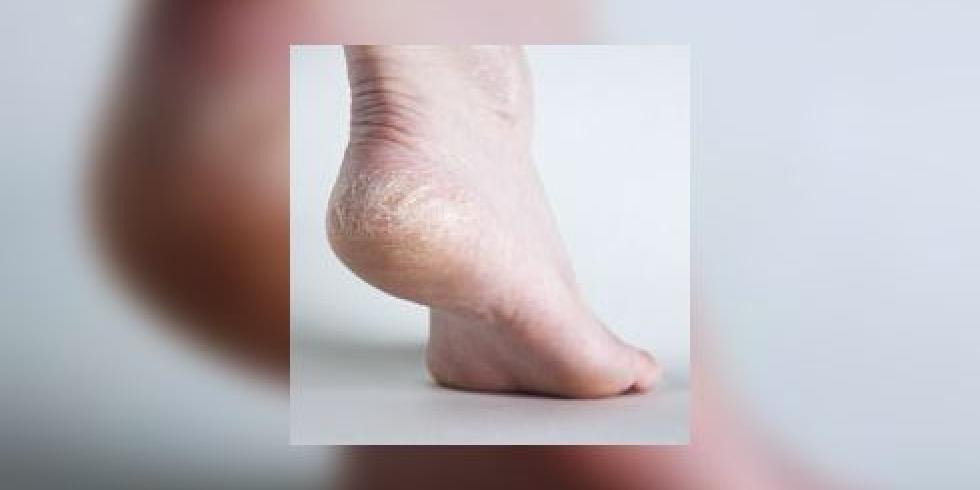 brug Pittig openbaring Kloven in de voeten: kloven in de voeten opsporen en verzorgen |  e-gezondheid.be | Drupal